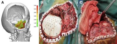 Surgical technique of temporal muscle resuspension during cranioplasty for minimizing temporal hollowing: A case series